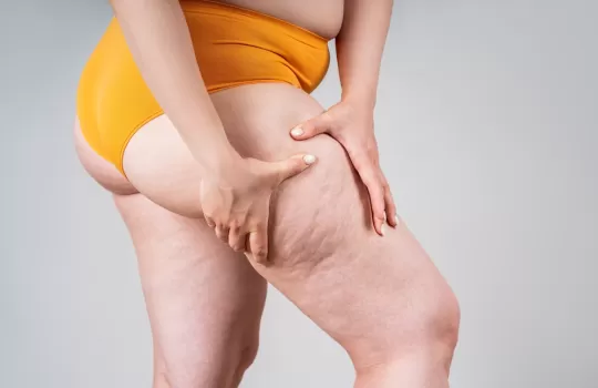 Lipodem Tedavisi 3